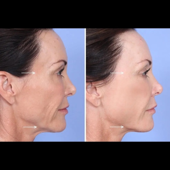 Professional PLLA Collagen Booster
- Volumizing & Skin Firming (1
Sealed Vial) - Picture 4 of 5